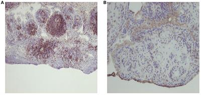 The Utility and Limitations of CRP, ESR and DAS28-CRP in Appraising Disease Activity in Rheumatoid Arthritis